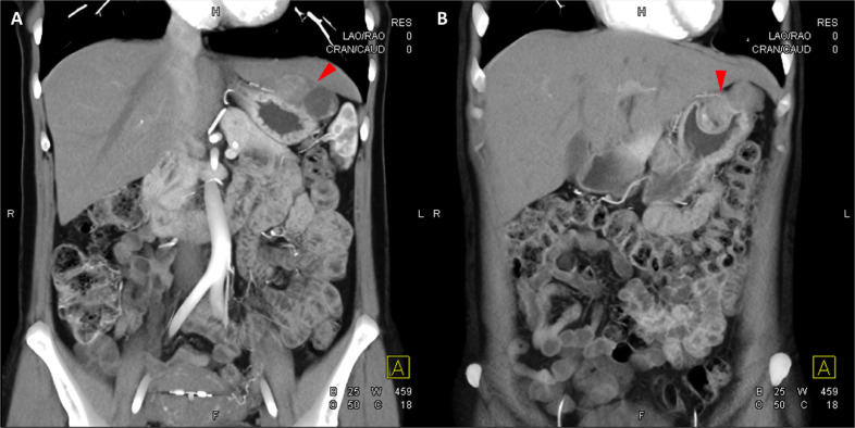 【佳学基因检测】Carney-Stratakis综合征遗传阻断基因检测 【佳学基因检测】Carney-Stratakis综合征遗传阻断基因检测