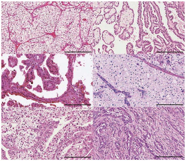 【佳学基因检测】肾脏癌靶向药物基因检测（Kidney Cancer)