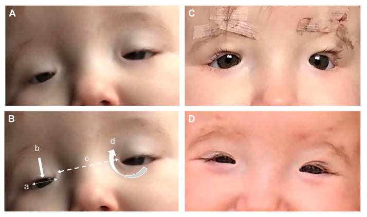 【佳学基因检测】睑裂狭小综合征Blepharophimosis syndrome基因解码、基因检测