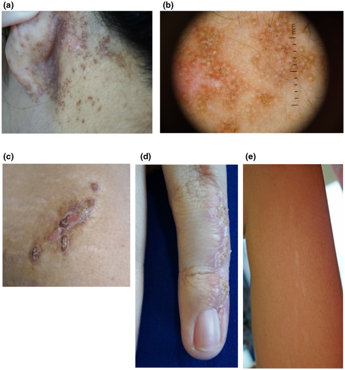 【佳学基因检测】CHILD综合征基因解码、基因检测有什么用？
