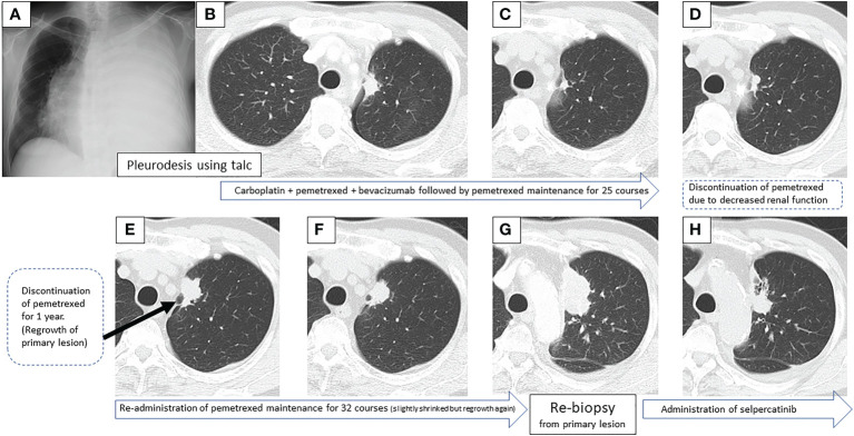【佳学基因检测】肺癌靶向药物基因检测为什么要包含RET重排