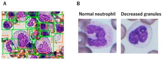 【佳学基因检测】CRYGB基因评估分析找到病因后应该用什么靶向药物？